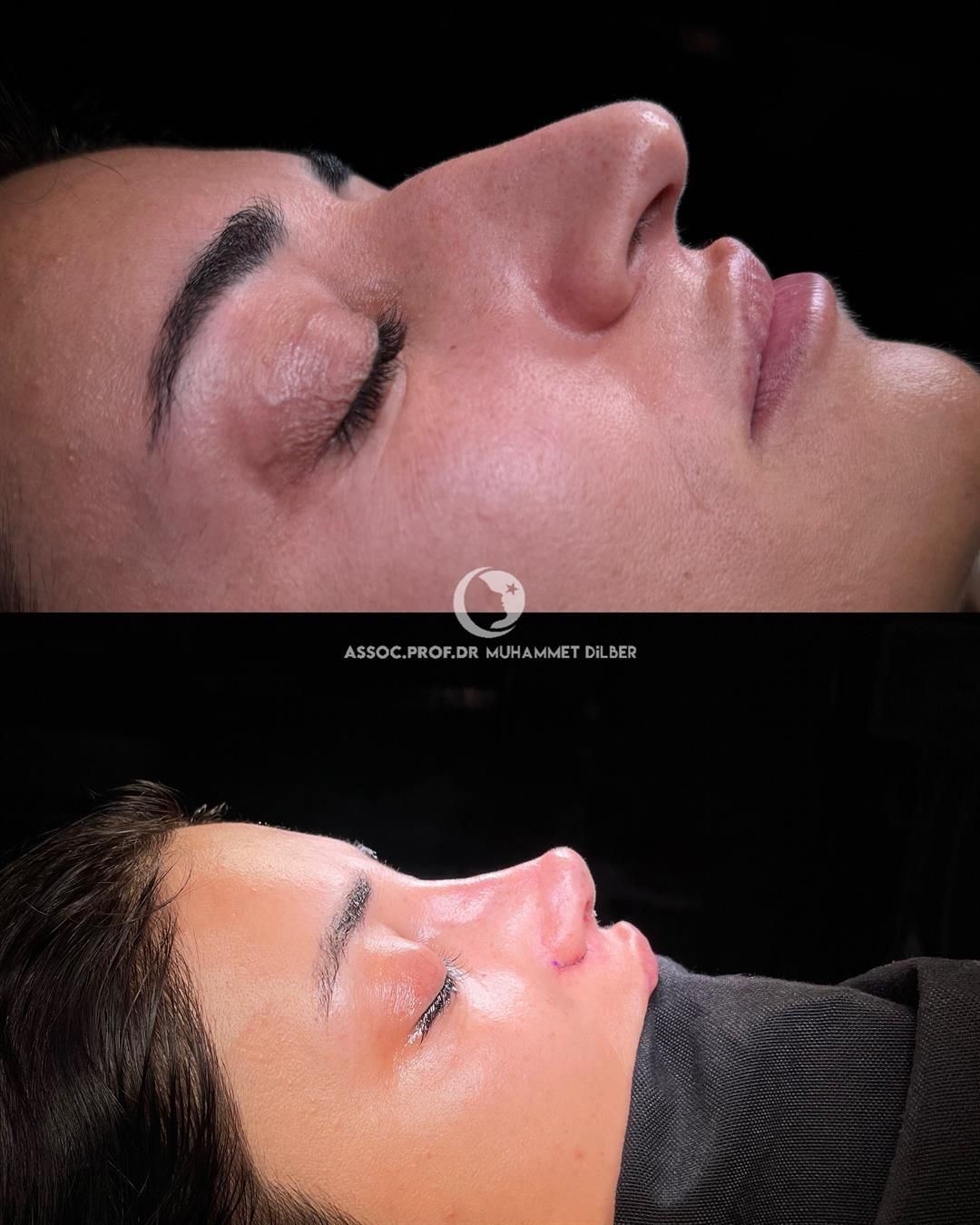 From a Surgeon's Perspective: How to Choose the Best Rhinoplasty Surgeon for You